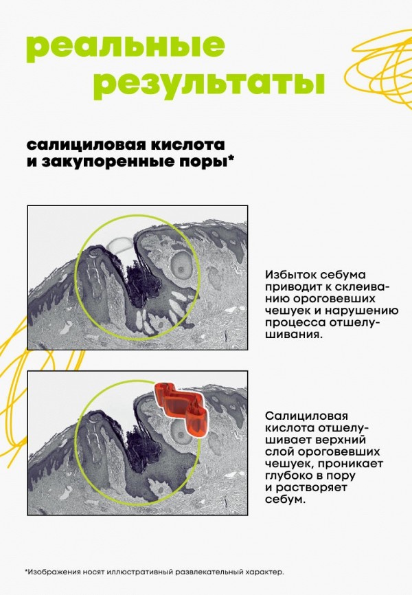 De_code Лосьон для лица - для молодой кожи с салициловой кислотой против прыщей и черных точек, 150 мл - фото 6
